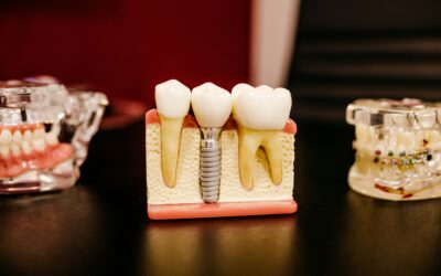 Can You Get Dental Implants After Years of Wearing Dentures?