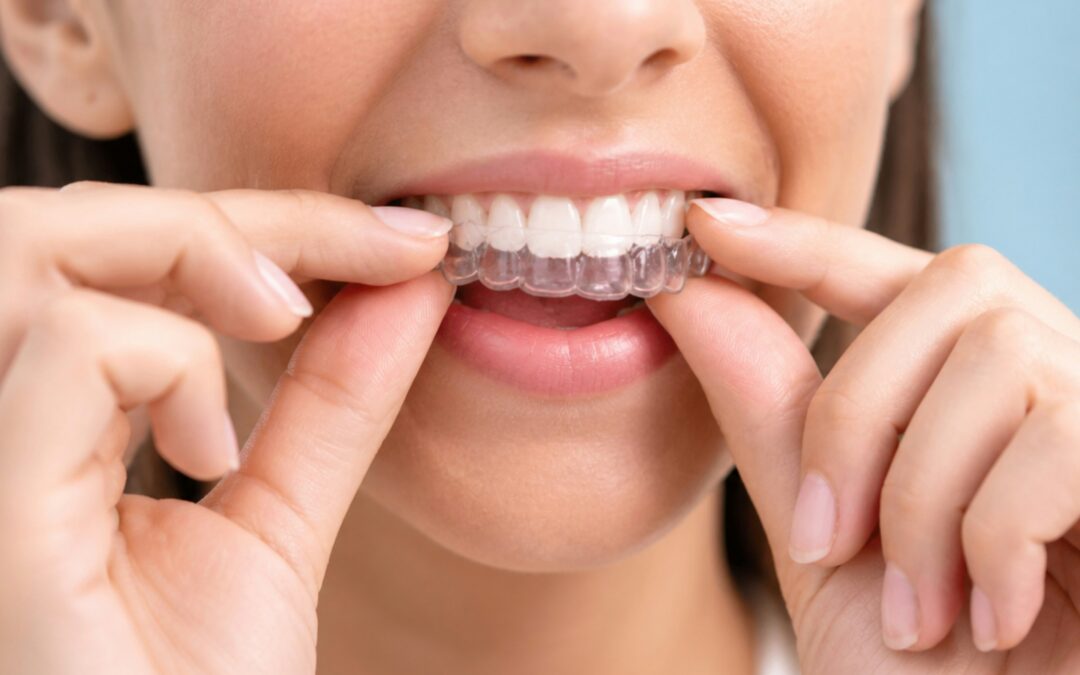 Person fitting a clear Invisalign aligner onto their teeth